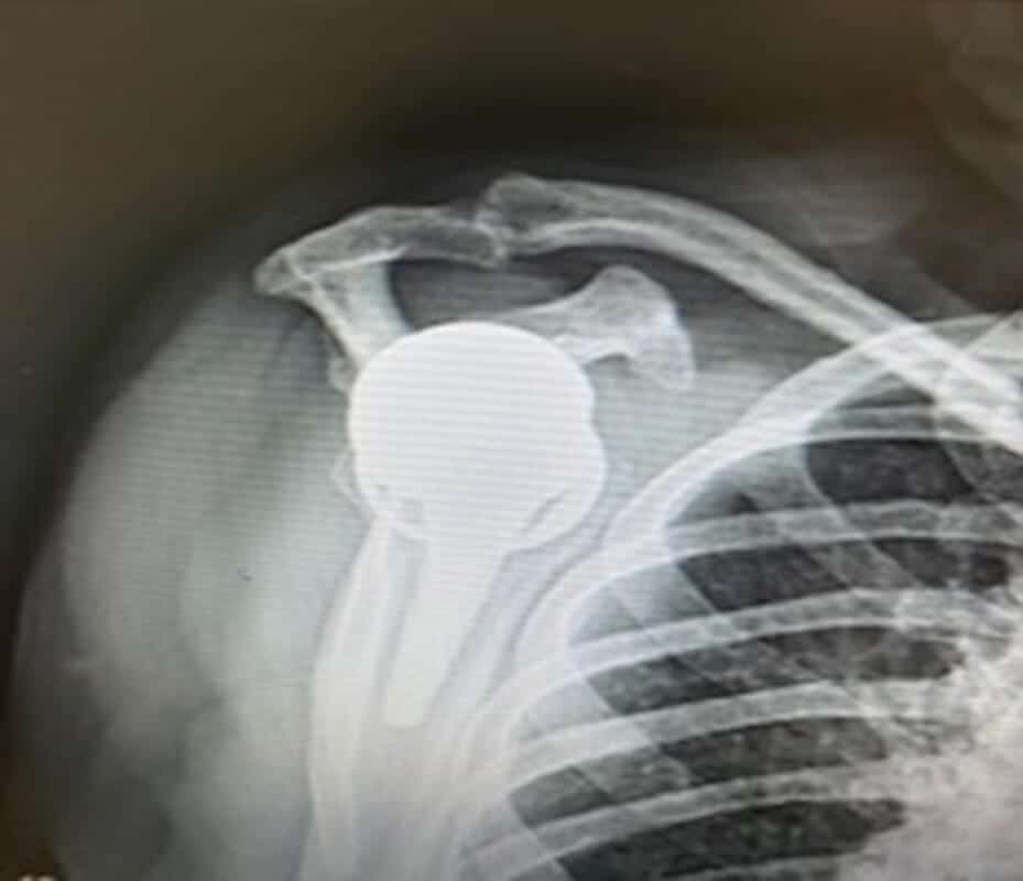 Exactech, Preserve - American Shoulder and Elbow Surgeons