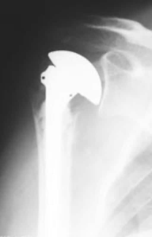DePuy, Global Fracture - American Shoulder and Elbow Surgeons